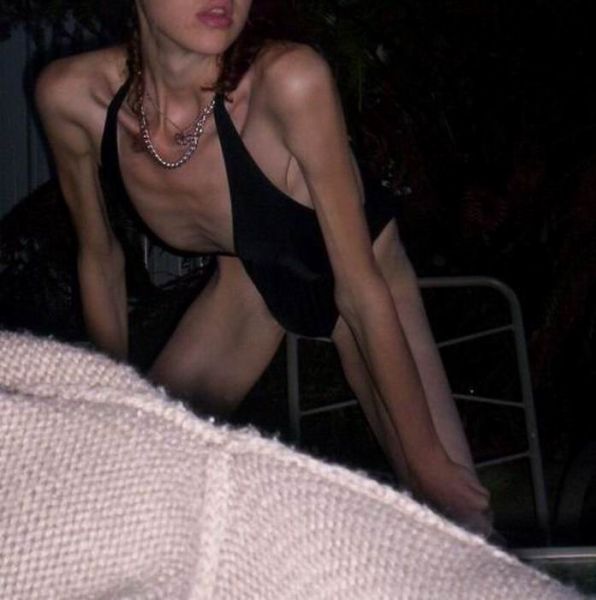 Tjejer med anorexia – bild 2 av 44