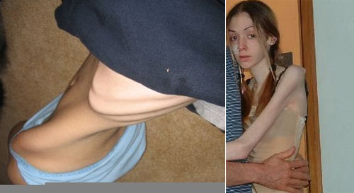 Tjejer med anorexia – bild 3 av 44