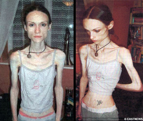 Tjejer med anorexia – bild 4 av 44