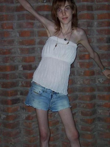 Tjejer med anorexia – bild 5 av 44
