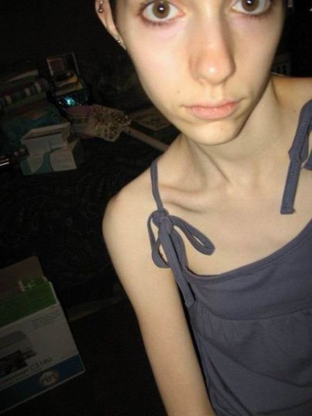 Tjejer med anorexia – bild 9 av 44