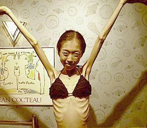 Tjejer med anorexia – bild 11 av 44
