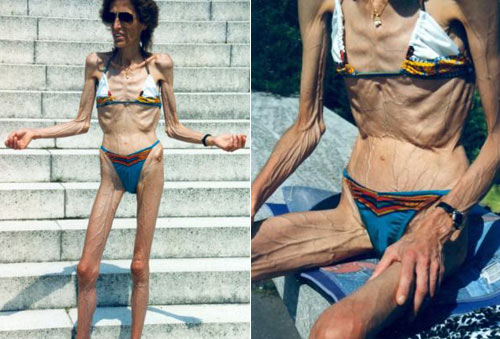 Tjejer med anorexia – bild 13 av 44