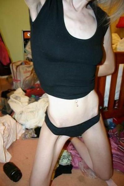 Tjejer med anorexia – bild 16 av 44