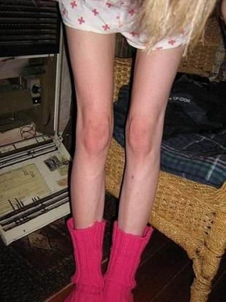 Tjejer med anorexia – bild 17 av 44