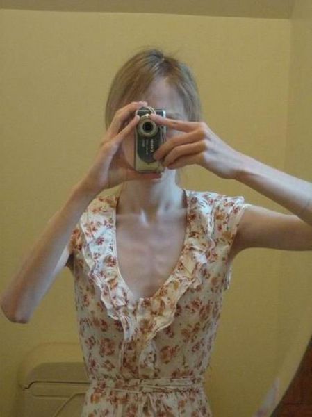 Tjejer med anorexia – bild 18 av 44