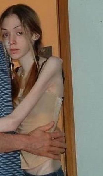 Tjejer med anorexia – bild 22 av 44