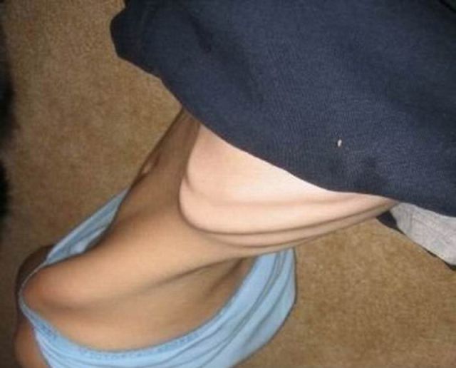 Tjejer med anorexia – bild 23 av 44