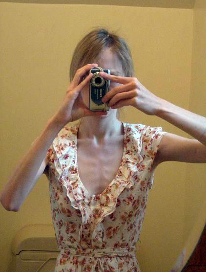 Tjejer med anorexia – bild 25 av 44