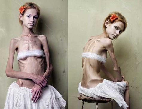 Tjejer med anorexia – bild 28 av 44