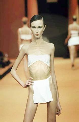Tjejer med anorexia – bild 29 av 44