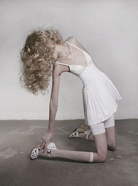 Tjejer med anorexia – bild 31 av 44