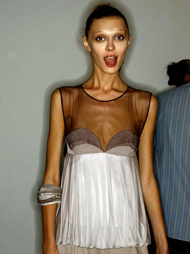 Tjejer med anorexia – bild 38 av 44