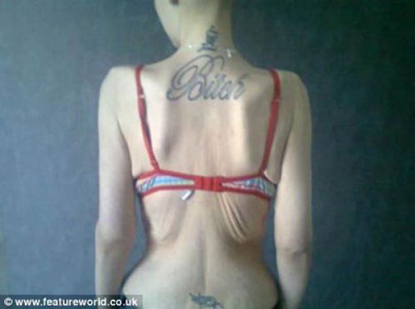 Från fetman till anorexia – bild 9 av 10