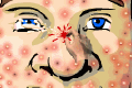 Bild från Acne Be Gone