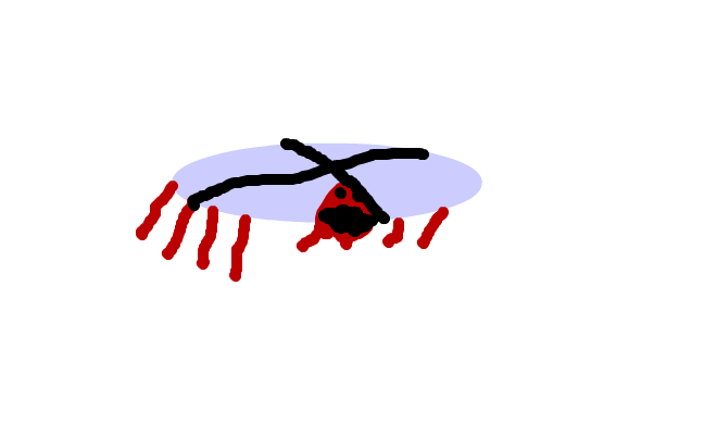 gift spindel