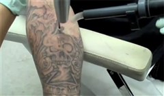 Bild från Tar bort tatuering
